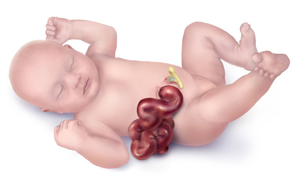 Illustration of a baby with gastroschisis