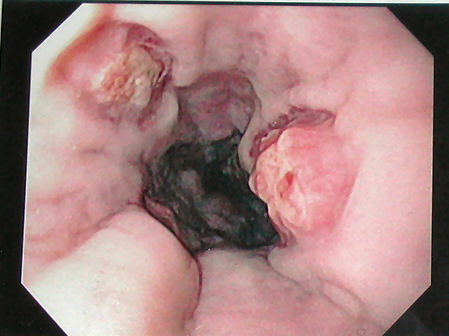 Esophageal ulcers after banding.
