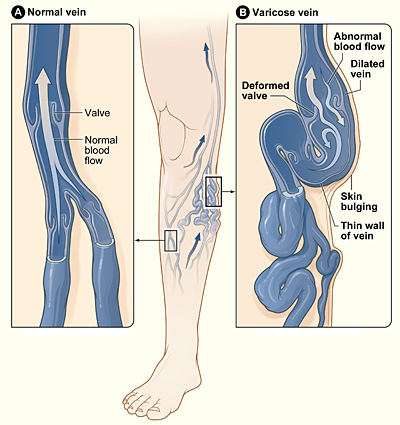 The illustration shows how a varicose vein forms in a leg. Figure A shows a normal vein with a working valve and normal blood flow. Figure B shows a varicose vein with a deformed valve, abnormal blood flow, and thin, stretched walls. The middle image shows where varicose veins might appear in a leg.