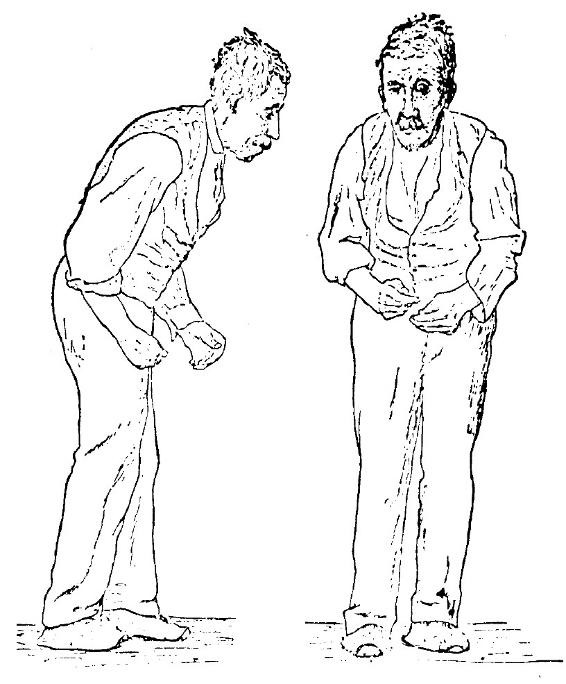 Sir William Richard Gowers, neurologist, researcher and artist, drew this illustration in 1886 as part of his documentation of Parkinson's Disease. The image appeared in his book, A Manual of Diseases of the Nervous System, still used today by medical professionals as a primary reference for this disease. Idiopathic or primary parkinsonism, hypokinetic rigid syndrome, paralysis agitans



