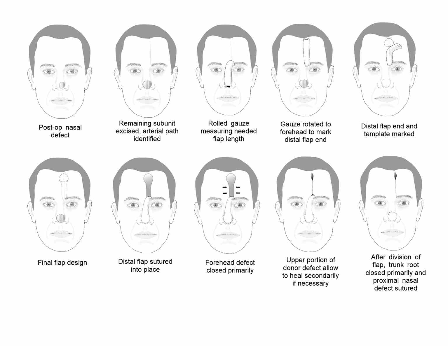 Forehead flap summary diagrams