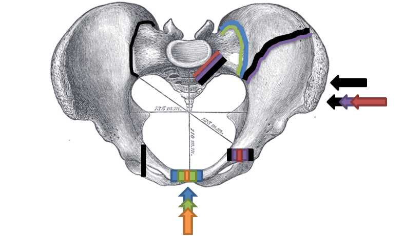 Superior view, Pelvic Fracture Types/Force and break are shown by matching letter and color: A. Anteroposterior compression type I, B. Anteroposterior compression type II, C. Anteroposterior compression type III; D. Lateral compression type I, E. Lateral compression type II, F. Lateral compression type III/Increased force and breaks are shown by increasing size.