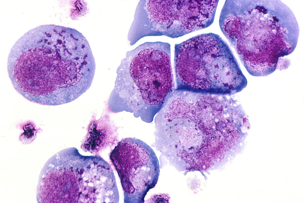  This is a histological slide of the human herpes virus-6 (HHV-6) previously known as HBLV, a type of herpes virus that was discovered in October, 1986. This is a photomicrograph of infected cells, with inclusion bodies in both the nucleus and the cytoplasm. The slide is stained with H&E. Roseola infantum is caused by this type of virus.