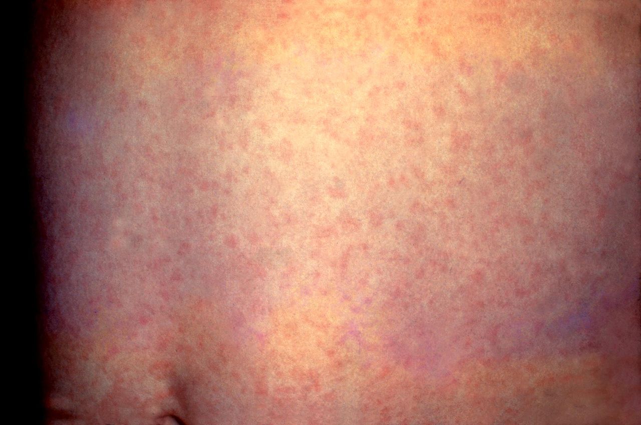 This patient presented with a generalized rash on the abdomen caused by German measles (rubella). The rash usually lasts about three days, and may be accompanied by a low grade fever. Rubella is caused by a different virus from the one that causes regular measles (rubeola). Immunity to rubella does not protect a person from measles, or vice versa.