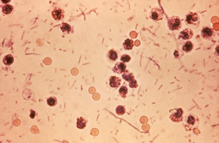This photomicrograph revealed stool exudates in a patient with shigellosis, which is also known as “Shigella dysentery”, or “Bacterial dysentery”. Usually, those who are infected with Shigella develop diarrhea, which is often bloody, fever, and stomach cramps starting a day or two after they are exposed to the bacterium. Shigellosis usually resolves in 5 to 7 days.