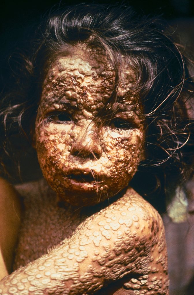 This young girl in Bangladesh was infected with smallpox in 1973, Freedom from smallpox was declared in Bangladesh in December, 1977 when a WHO International Commission officially certified that smallpox had been eradicated from that country