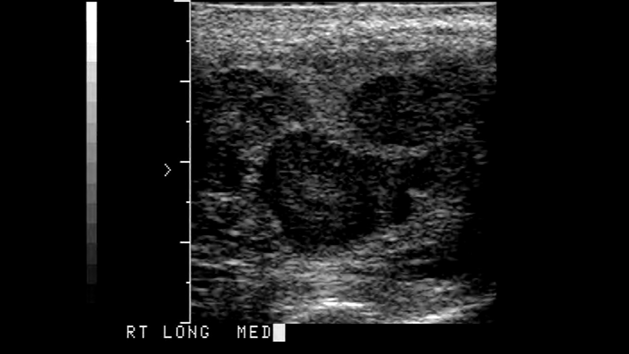 Ultrasound image of Seminoma of the Testicle 
