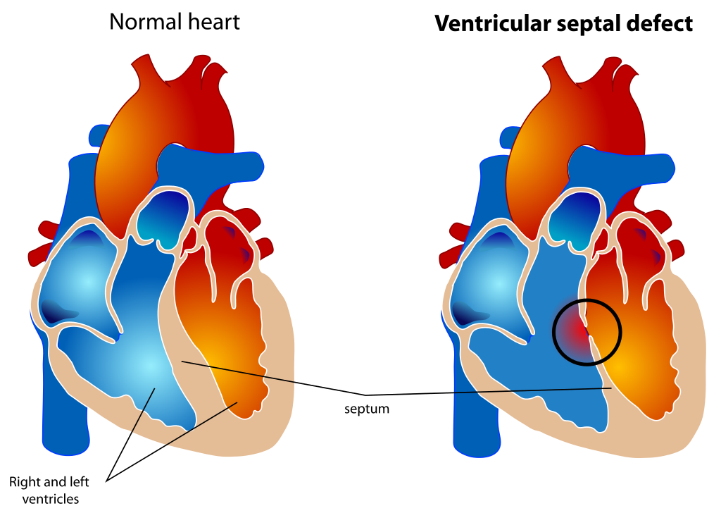 The diagram shows a healthy heart and one suffering from Ventricular Septal Defect