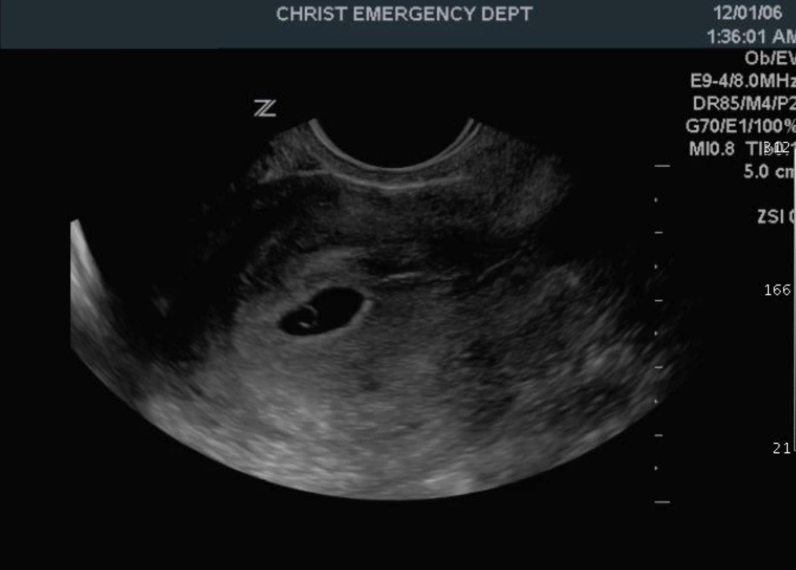 Uterus weeks 6 tilted ultrasound Pregnancy: 8