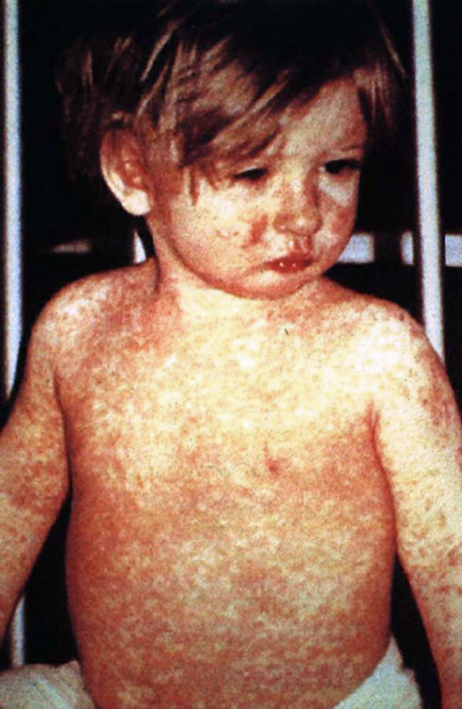 <p>Measles, Day-4 Rash. This child shows a classic day-4 rash with measles.</p>