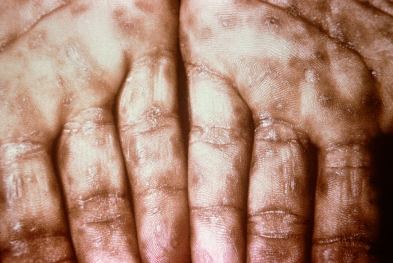 This photograph shows a close-up view of keratotic lesions on the palms of this patient’s hands due to a secondary syphilitic infection. Syphilis is a complex sexually transmitted disease (STD) caused by the bacterium Treponema pallidum. It has often been called "the great imitator" because so many of the signs and symptoms are indistinguishable from those of other diseases.