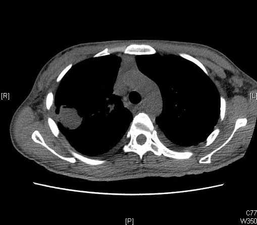 Pulmonary Pathology, Lungs, Aspergilloma CT Scan, Mycetoma, Fungus, CT Scan, Computed Tomography 