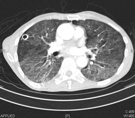 Lung Abscess, CT Scan, Computer Tomography, Thick-walled cavitary lesion in the right lung is an abscess, Diffuse ground glass infiltrates that are present in both lungs represent pneumonia