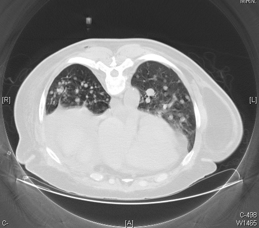 Metastatic follicular thyroid carcinoma, CT Scan