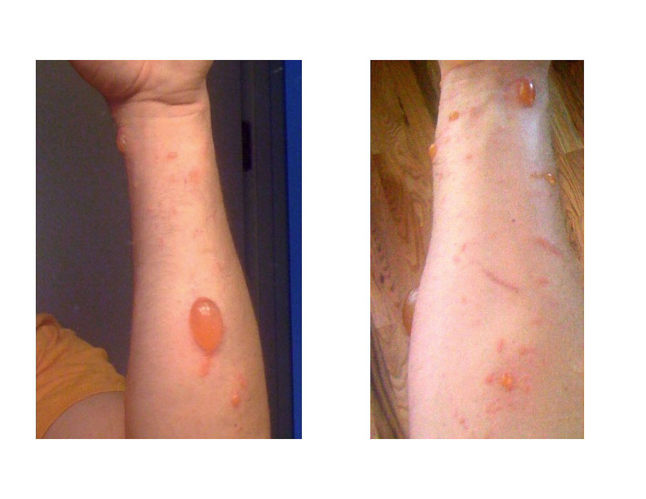 Contact dermatitis on arms after 72 hours of contact with poison ivy.