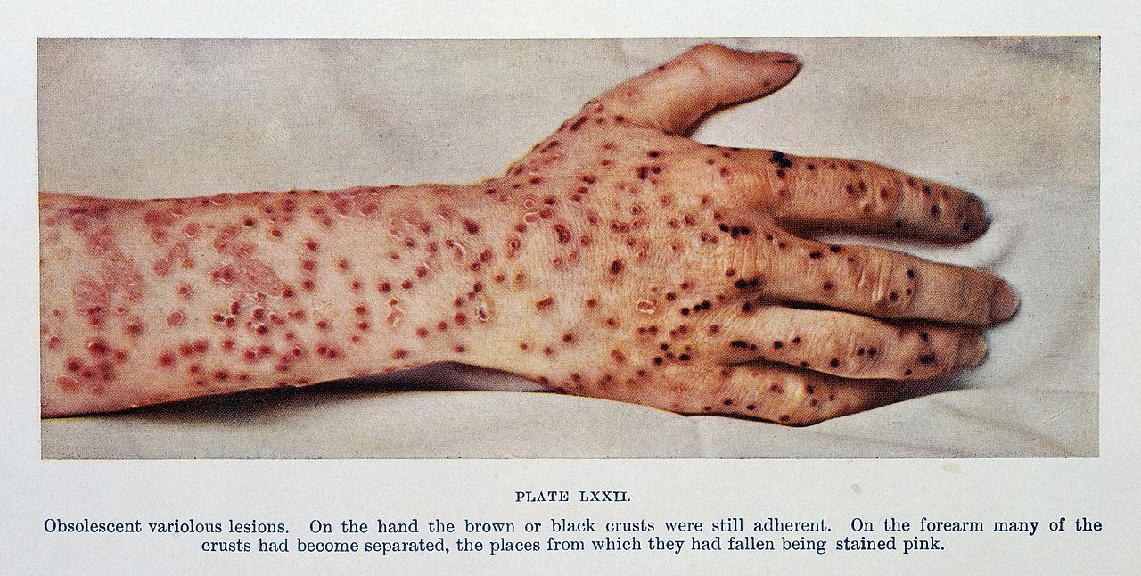Obsolescent variolous lesions, smallpox