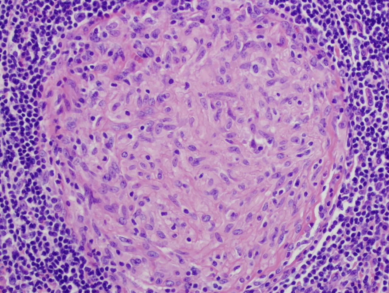 Picture of a granuloma (without necrosis) as seen through a microscope on a glass slide. The tissue on the slide is stained with two standard dyes (hematoxylin: blue, eosin: pink) to make it visible. The granuloma in this picture was found in a lymph node of a patient with Mycobacterium avium infection.