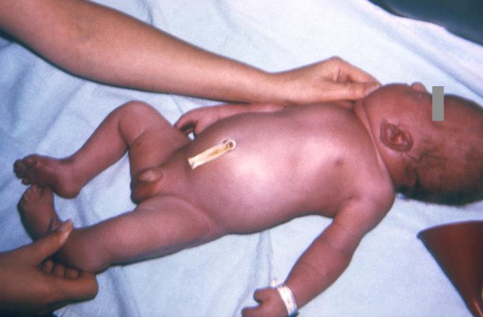 Pathology, Infant born with autosomal dominant disorder, Apert's Syndrome, Acrocephalosyndactyly, malformation of the cranium; face; hands; feet, Syndactyly 
