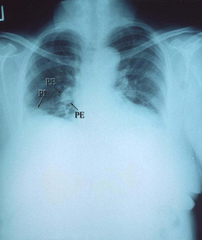 AP Chest x-ray, Right pulmonary arterial embolism, PE, Pulmonary infarction, PI, Ischemic Lung tissue due to the blockage