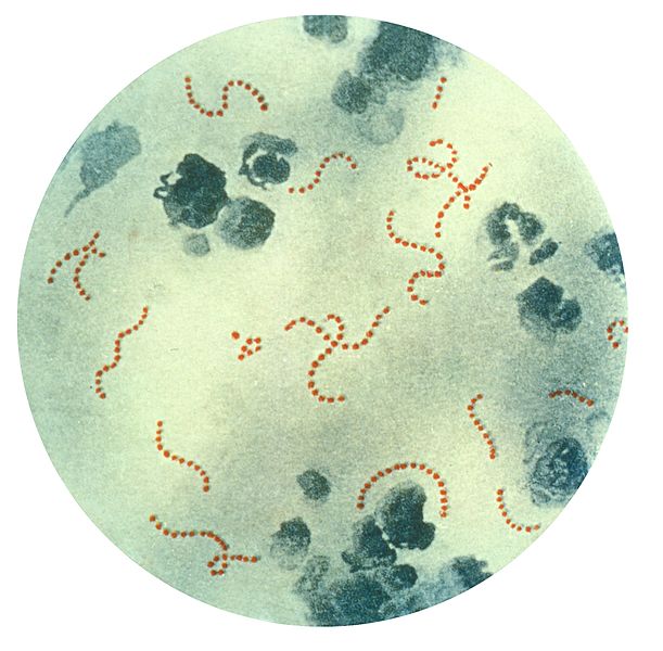 Photomicrograph, Streptococcus pyogenes, bacteria, Pus specimen, Pappenheim stain, Rheumatic fever, Pathology