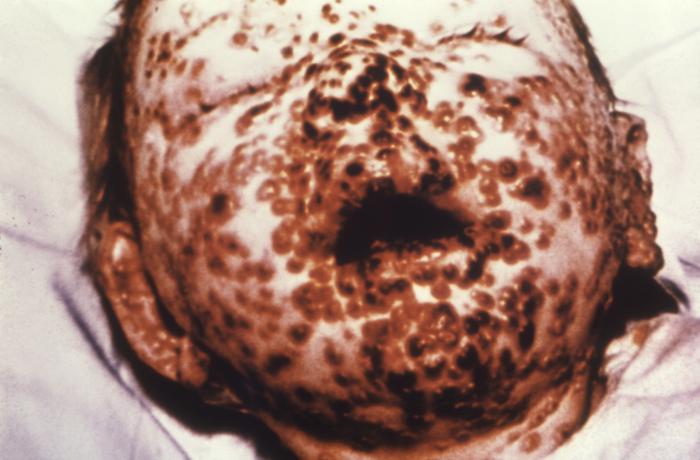 Face of a one year-old infant, Child, Smallpox virus, Dermatological manifestation, benign semi-confluent variola, 10th day post-onset, Variola Major and Minor