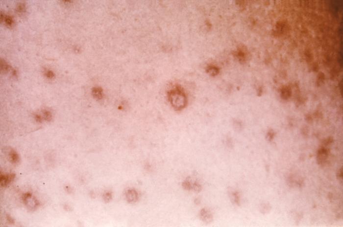 Pathology, Variola Major and Minor, Smallpox virus, Violaceous lesions, Lichenoid, Maculopapular manifestations