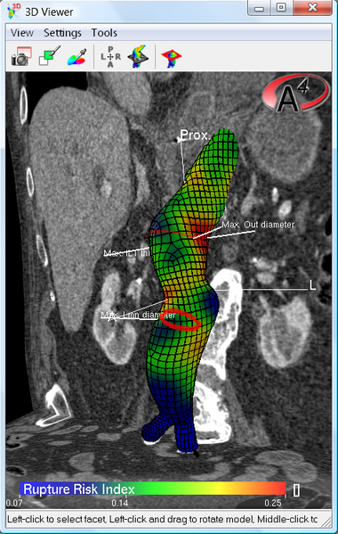 Color coded plot of the rupture risk index of the aneurysm wall,  Red portions are closest to the limit load (strength) of th
