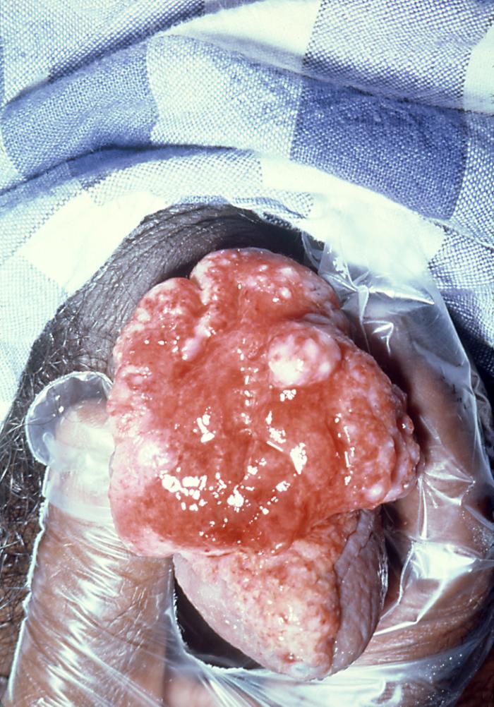 Pathology, Penis, Granuloma Inguinale, Klebsiella Infections, Simulated Carcinoma of the Penis, Donovanosis