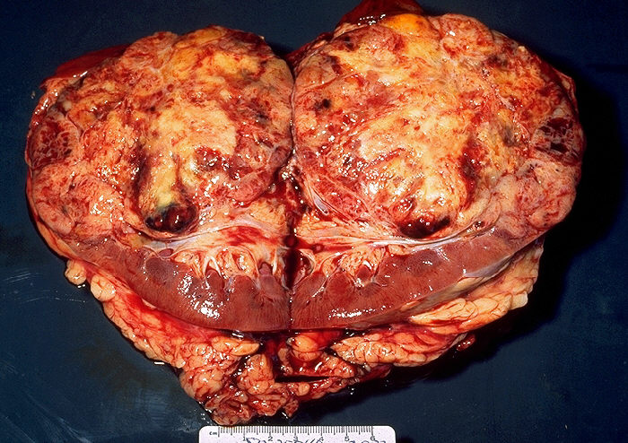 Gross Pathology of Bisected Kidney, Large Renal Cell Carcinoma, Tumor tissu, Renal cortex, Neoplasms