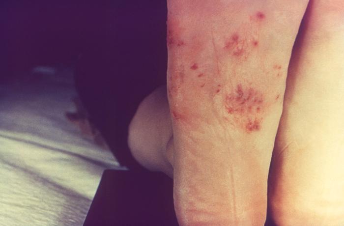 Rash, Tinea Pedis, Ringworm of the foot, dermatophytic fungal organism, Skin diseases, infectious, dermatomycoses