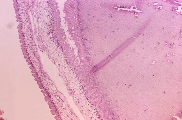 Photomicrograph, Brain tissue specimen revealed the presence of cysticerci, Cysticercosis, Eggs of a pork tapeworm, Taenia solium, Infestation of Brain Tissue, Neurocysticercosis, Parasitism, Pathology