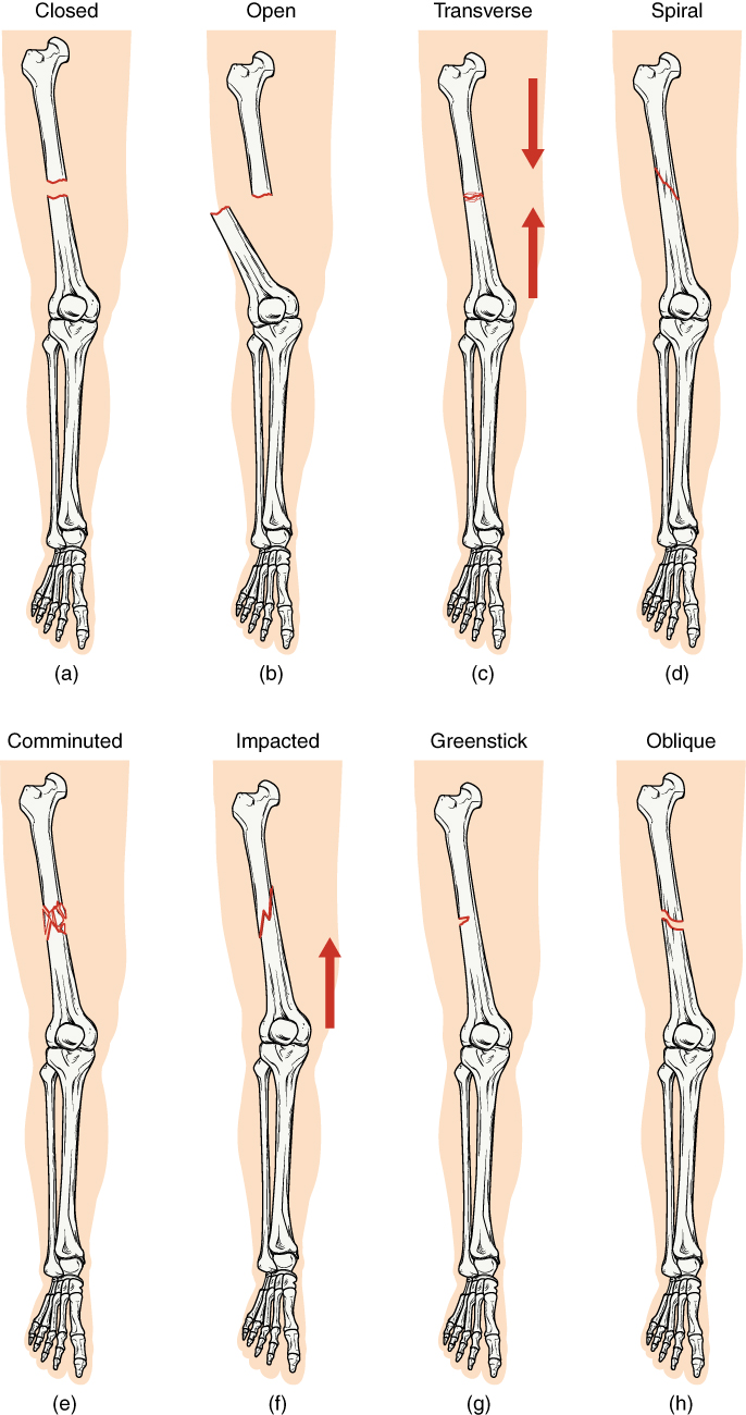 Bone, Different types of fractures, Closed Fracture, Open Fracture, Transverse Fracture, Spiral Fracture, Comminuted Fracture