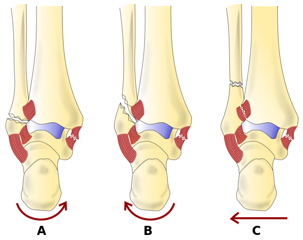 Weber classification of Ankle Fractures, Fracture, Dislocation, Leg, Heel, Foot