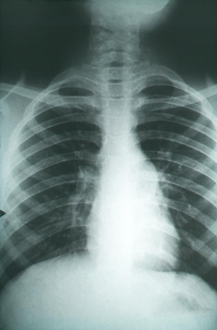 Anteroposterior chest x-ray, pulmonary fibrosis, Coccidioidomycosis, fungal organisms, scarring, resembling lung infections including tuberculosis, fungi 