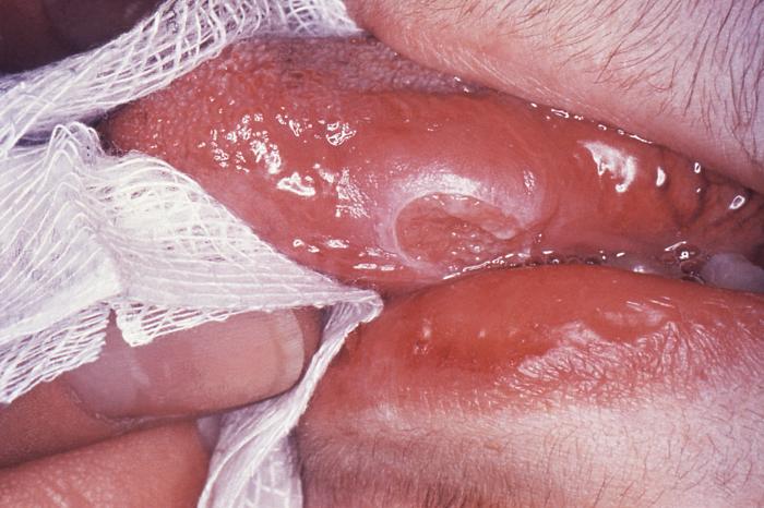 Tongue of Tuberculosis patient, lesion caused by Mycobacterium tuberculosis, erythematous connective tissue, eroded mucocutan