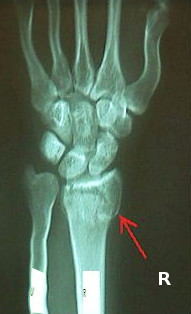 Colles, Wrist, X-ray