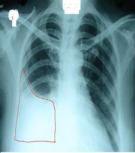 <p>X-Ray of Pleural Effusion in the Right Lung. The chest x-ray&nbsp;reveals a pleural effusion of the right lung.</p>