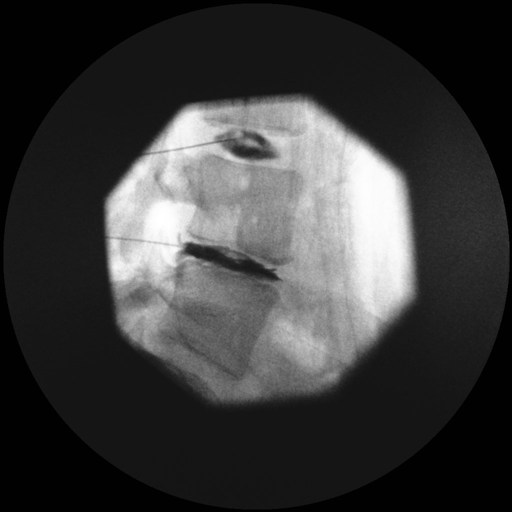 Provocative Discography, the L3-4 control disc appears lobular and was painless when pressurized, while the L4-5 disc had an irregular (fissured) appearance that produced concordant pain when subjected to relatively low pressures