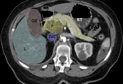 CT Scan, Liver, Gallbladder, Pancreas, Inferior Vena Cava, Aorta, Stomach, Courvosier