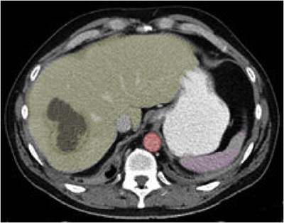Liverab, Liver abscess, CT Scan, hepatic