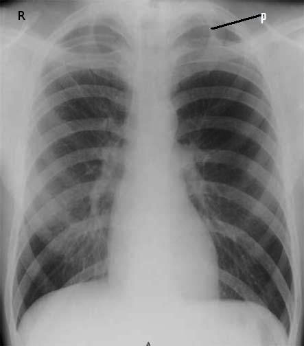 Apical Ptx, Primary Spontaneous pneumothorax, X-ray