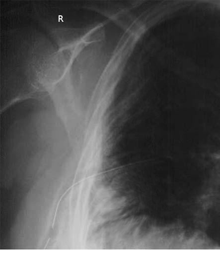 <p>Chest Tube, X-ray</p>