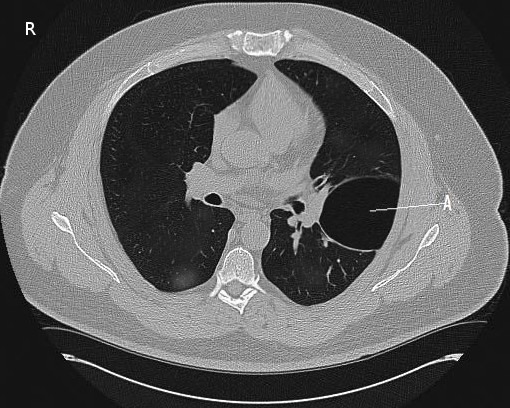 ct bulla, CT Scan, Pneumothorax 
