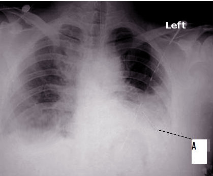Hemothorax, X-ray