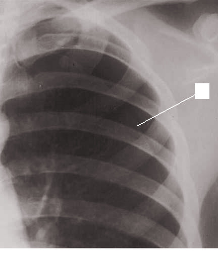 ptx line, Pneumothorax, x-ray