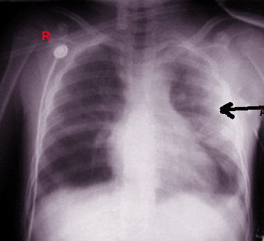 <p>Pulmonary&nbsp;Contusion Radiograph. This image shows a left pulmonary contusion.</p>