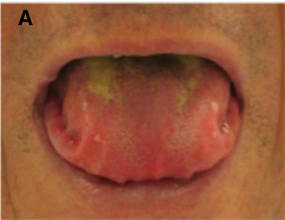 Systemic AL Amyloidosis, Pathology, Macroglossia with lateral scalloping of the tongue, mouth