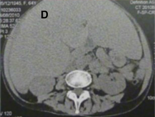 Systemic AL Amyloidosis, Pathology, Voluminous Hepatomegaly due to primary hepatic amyloidosis, Liver, CT scan