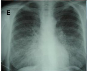 Systemic AL Amyloidosis, Pathology, Diffuse Bilateral interstitial lung disease, X-ray, scarring