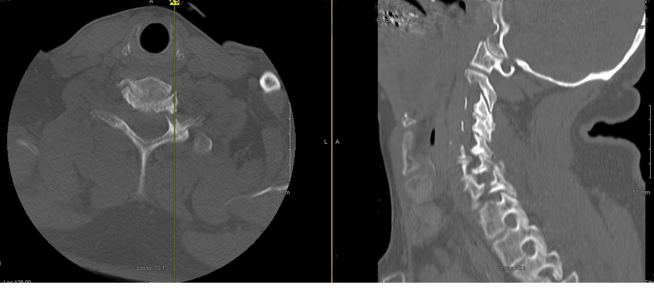 CT scan of C67 cervical spine fracture. This image shows an AP and Lateral CT scan with a fracture extending from the left pedicle of C7 through to the lamina of C6 following a motor vehicle accident.